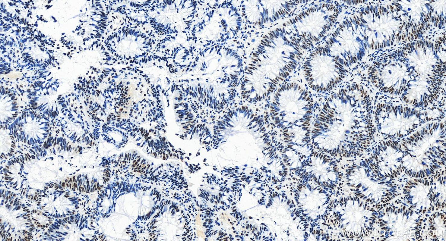 IHC staining of human colon cancer using 83891-6-RR