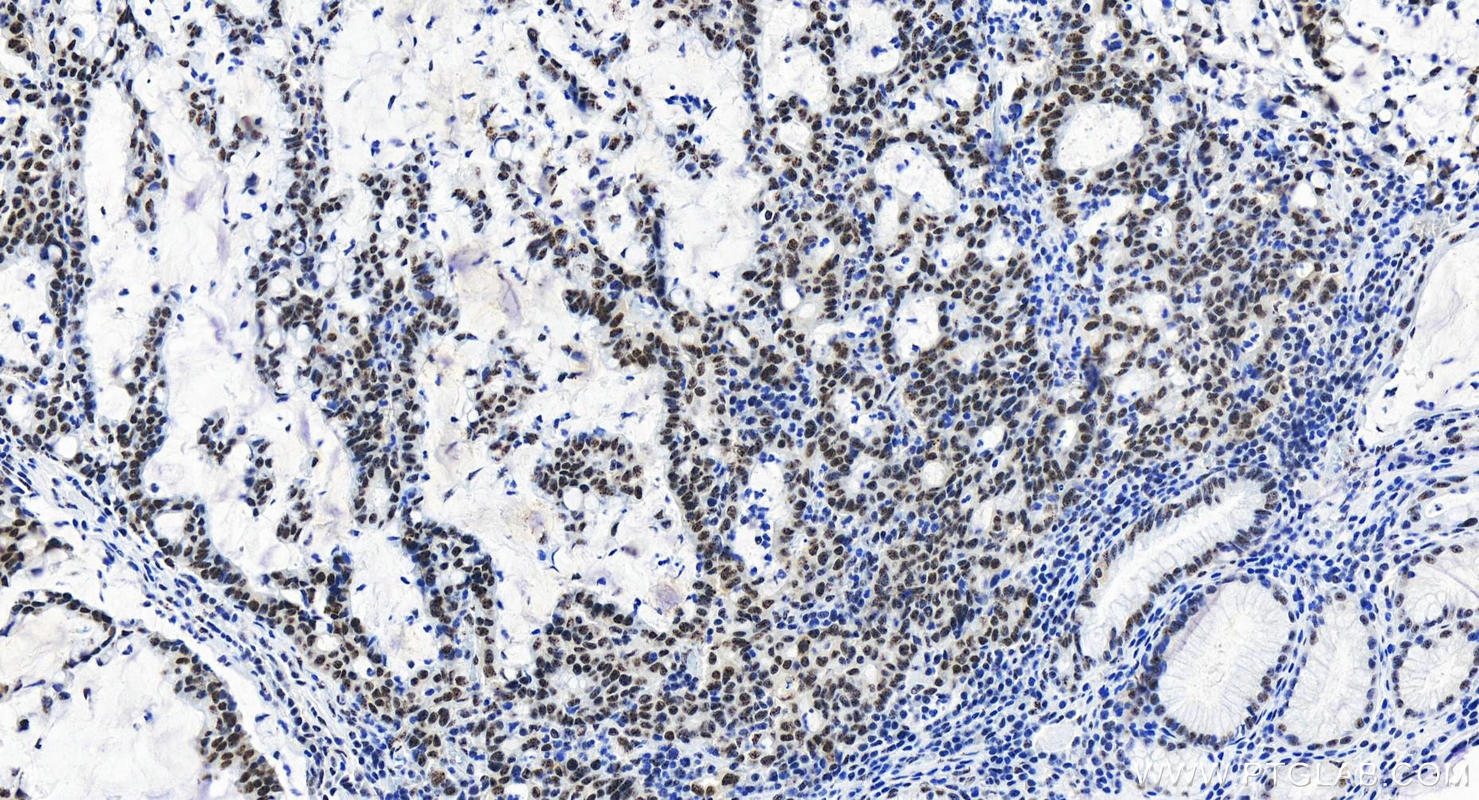 IHC staining of human stomach cancer using 83891-6-RR