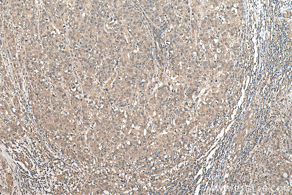 IHC staining of human breast cancer using 67579-1-Ig