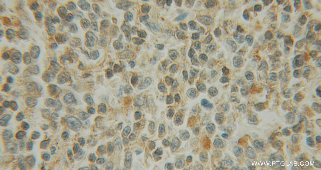IHC staining of human lymphoma using 12585-1-AP