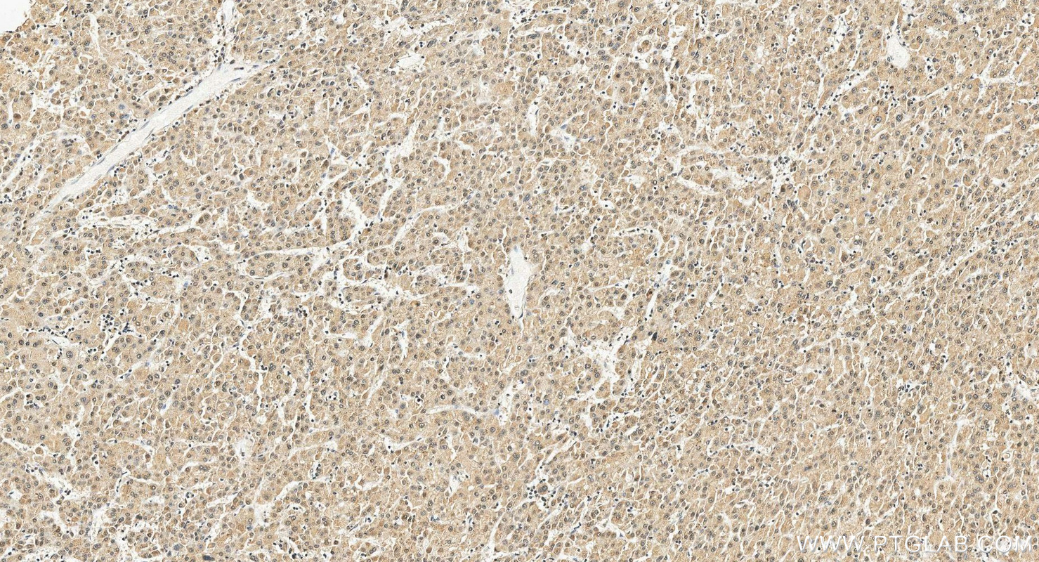 IHC staining of human liver cancer using 68315-1-Ig IHC staining of human liver cancer using 68315-1-Ig