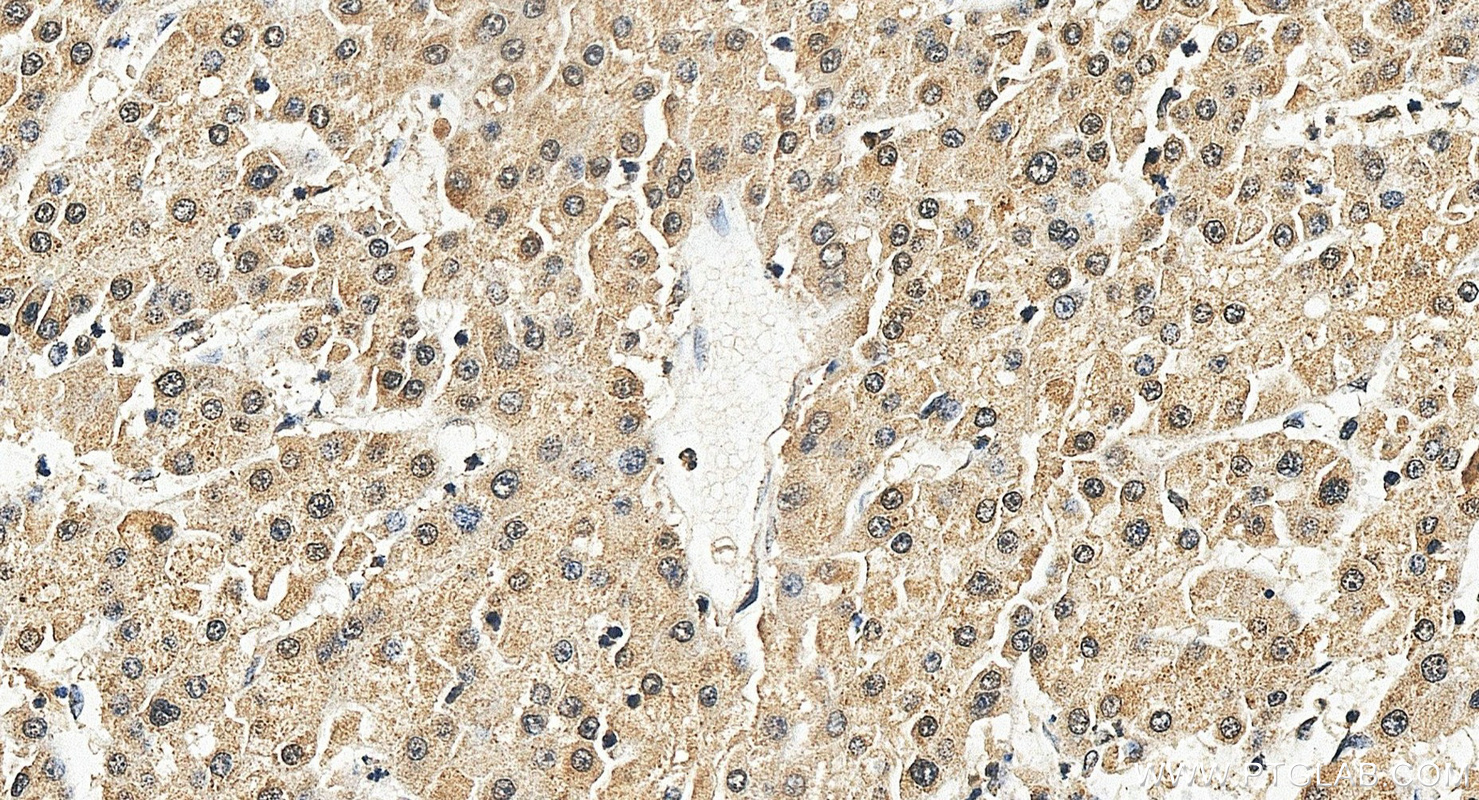 IHC staining of human liver cancer using 68315-1-Ig IHC staining of human liver cancer using 68315-1-Ig