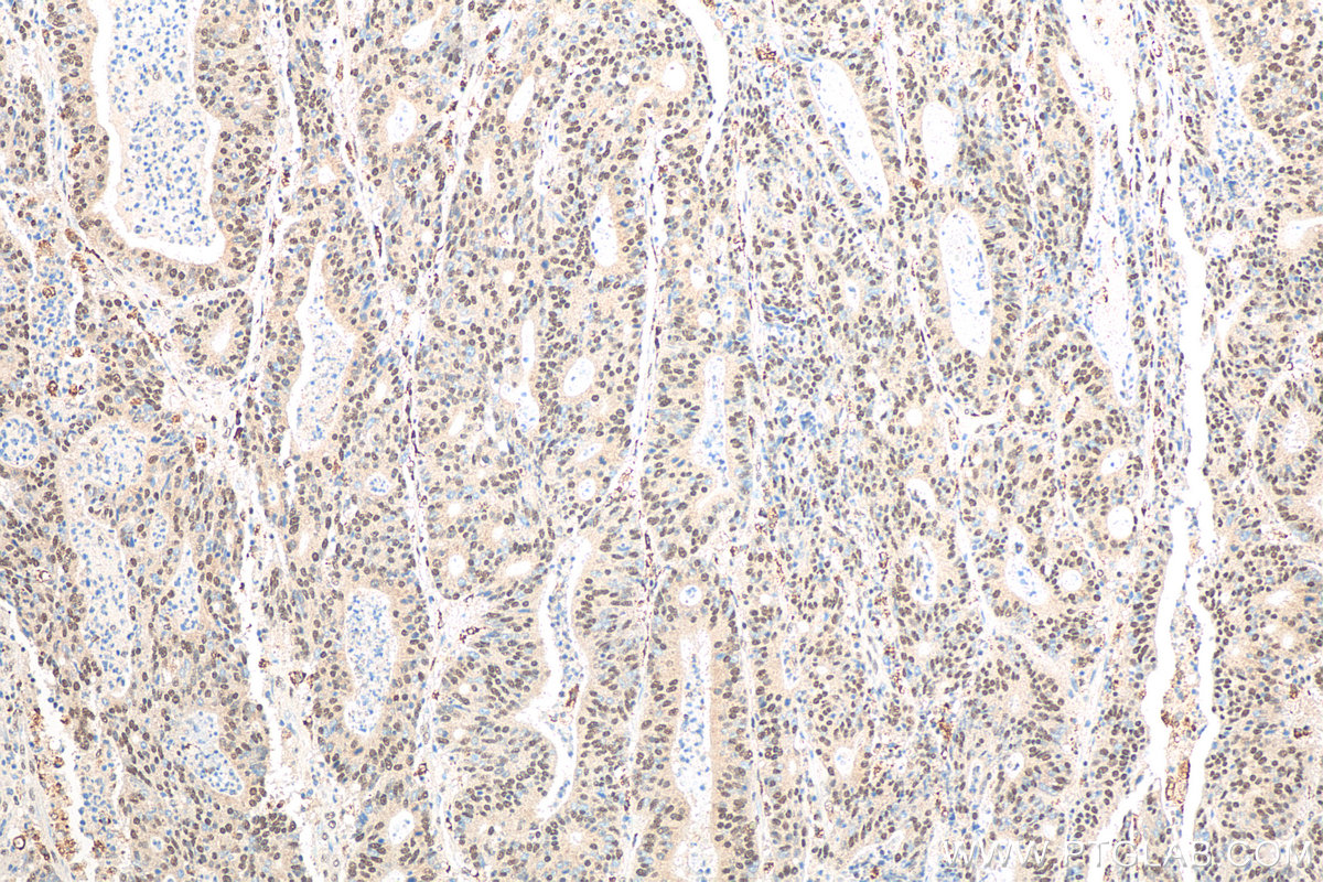 IHC staining of human colon cancer using 15062-1-AP