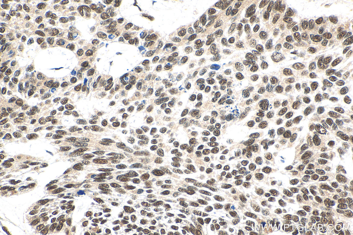 IHC staining of human skin cancer using 15937-1-AP