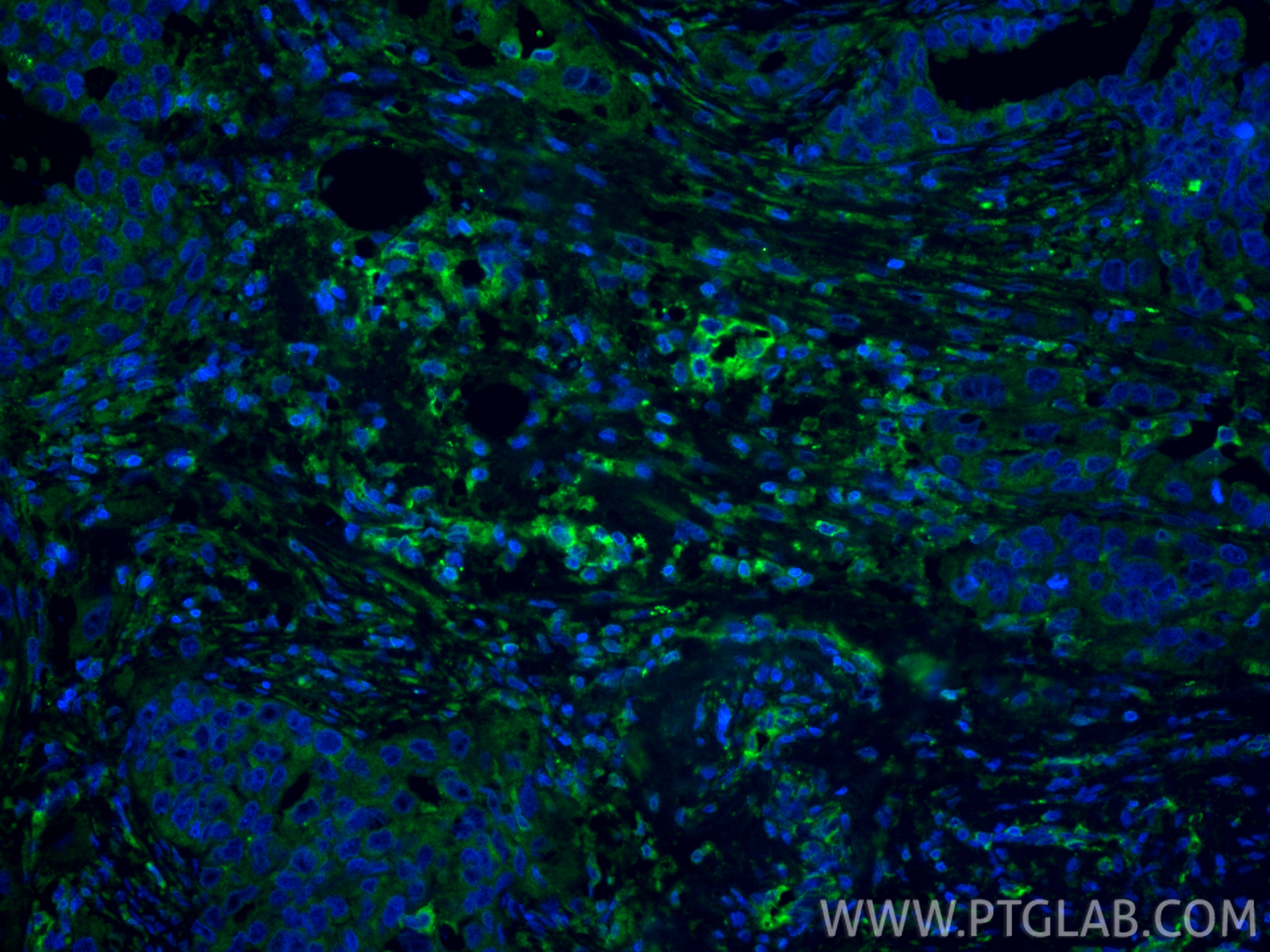 IF Staining of human colon cancer using 11348-1-AP