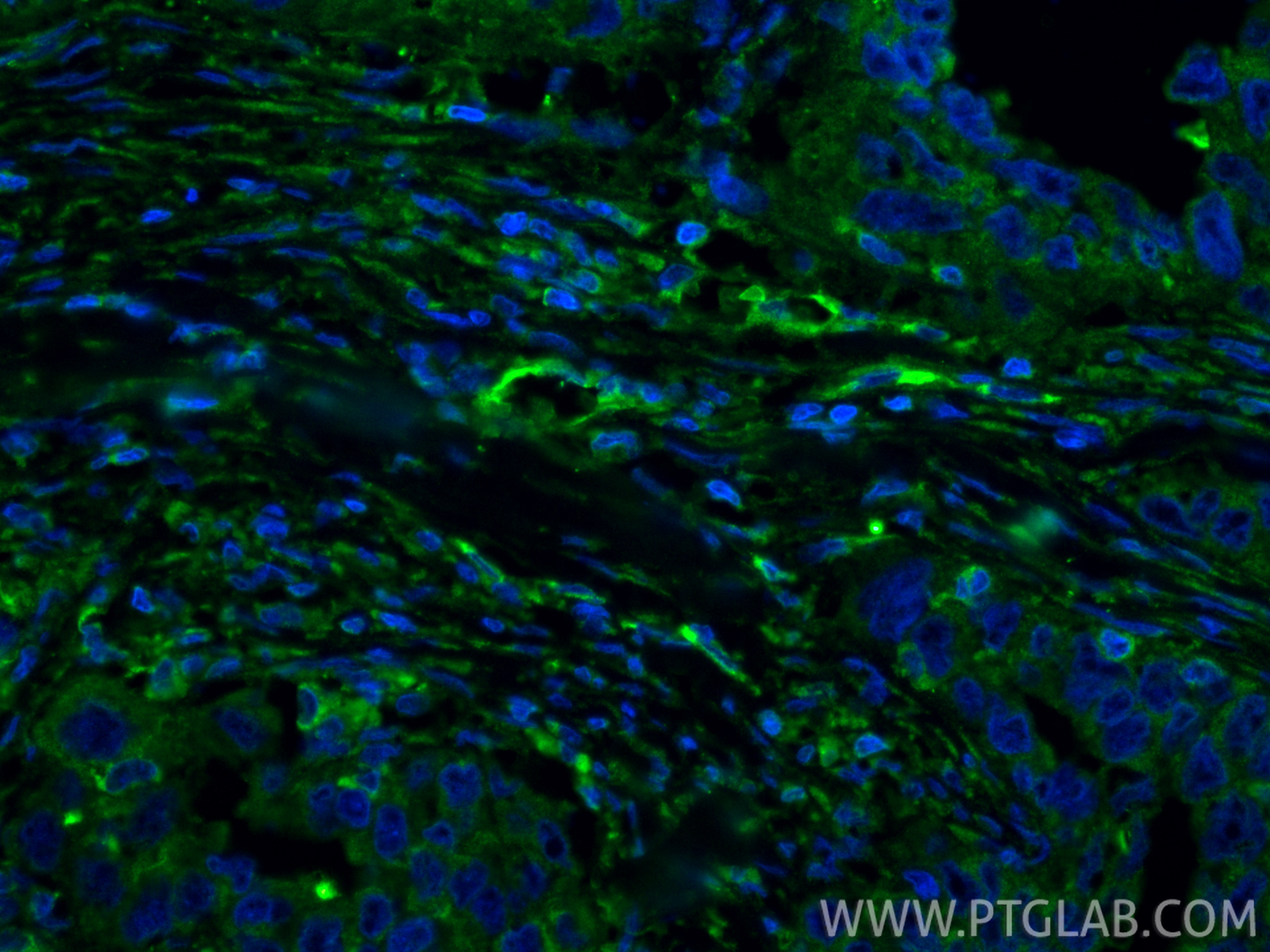 IF Staining of human colon cancer using 11348-1-AP