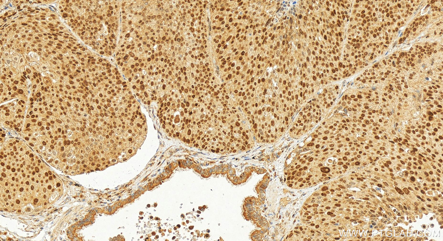IHC staining of human lung squamous cell carcinoma using 21800-1-AP