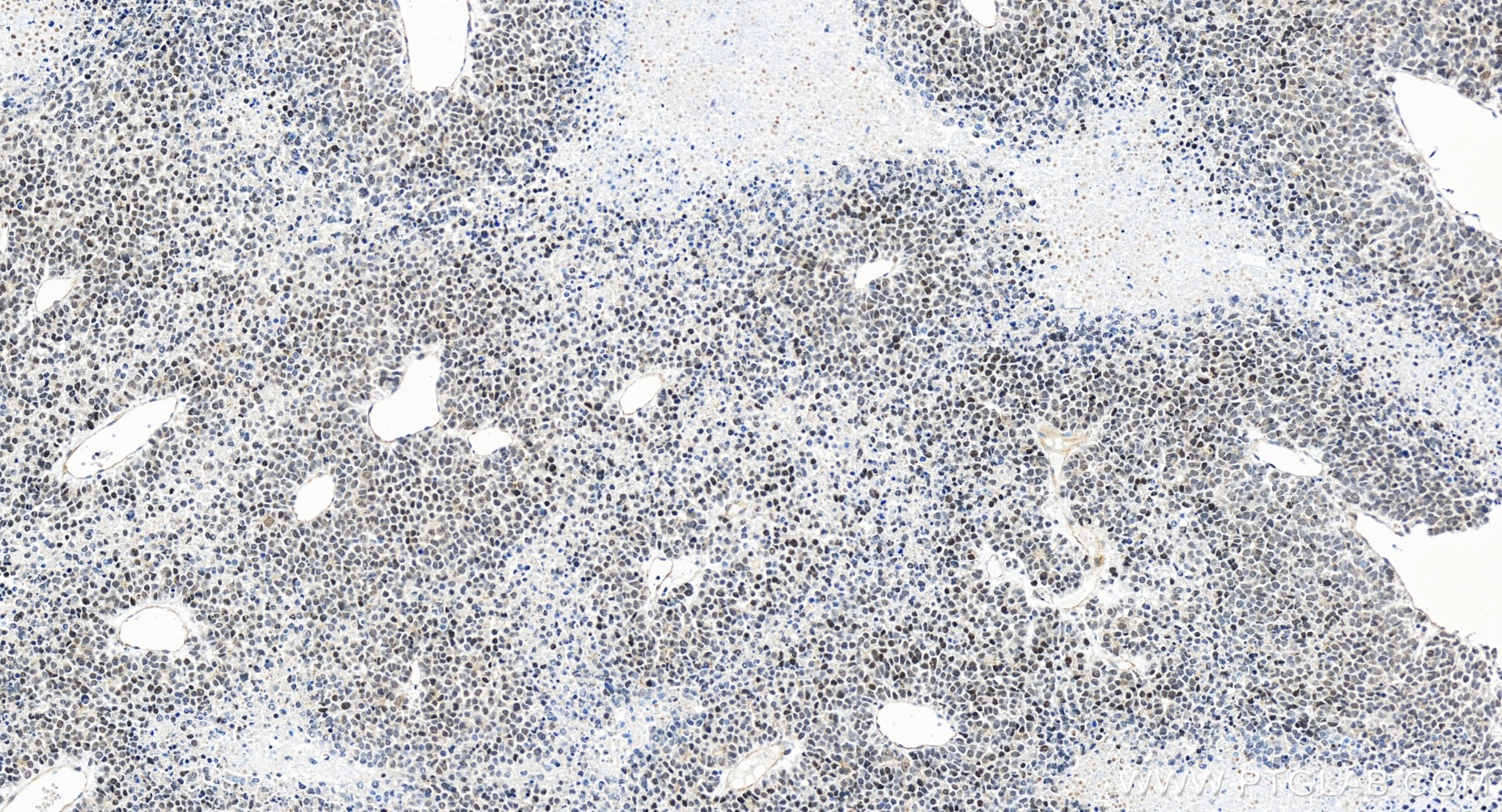IHC staining of human liver cancer using 84824-2-RR