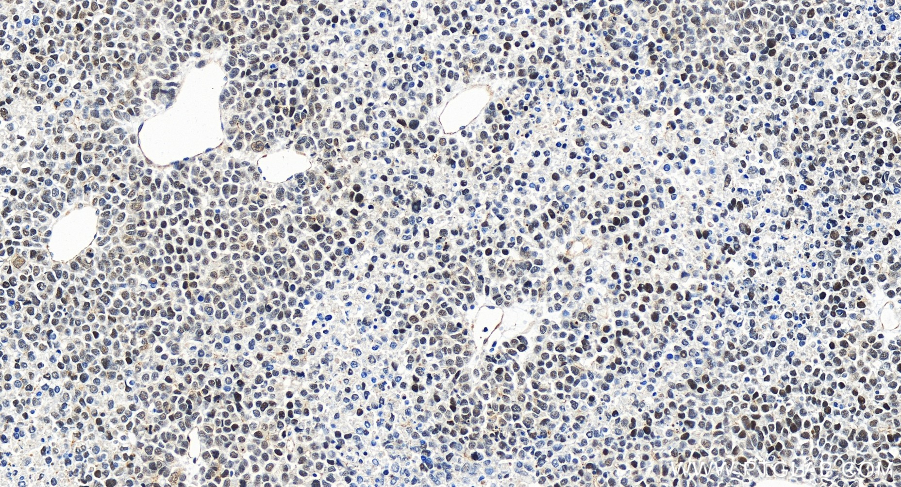 IHC staining of human liver cancer using 84824-2-RR