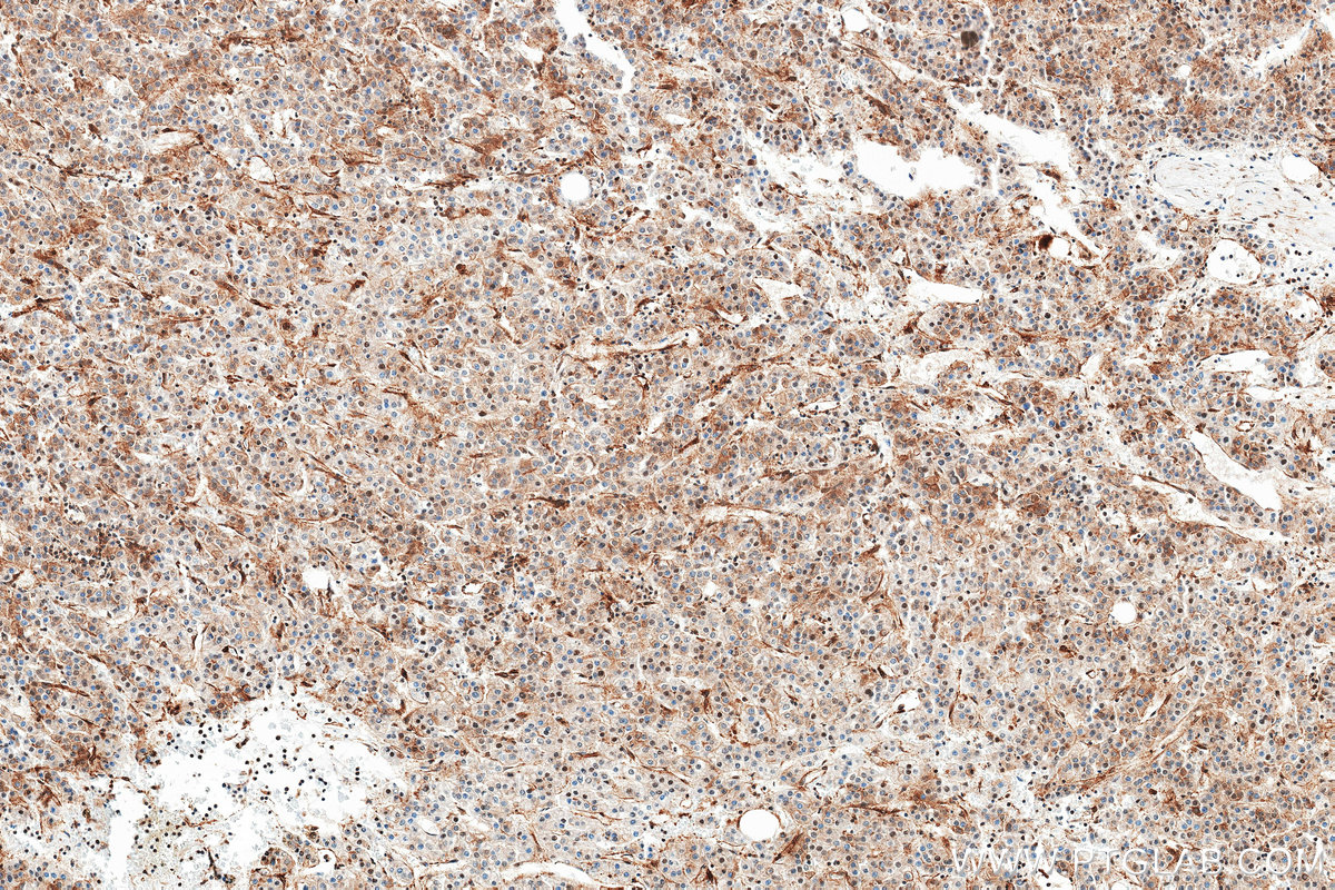 IHC staining of Human Hepatocellular cancer using 84824-2-RR