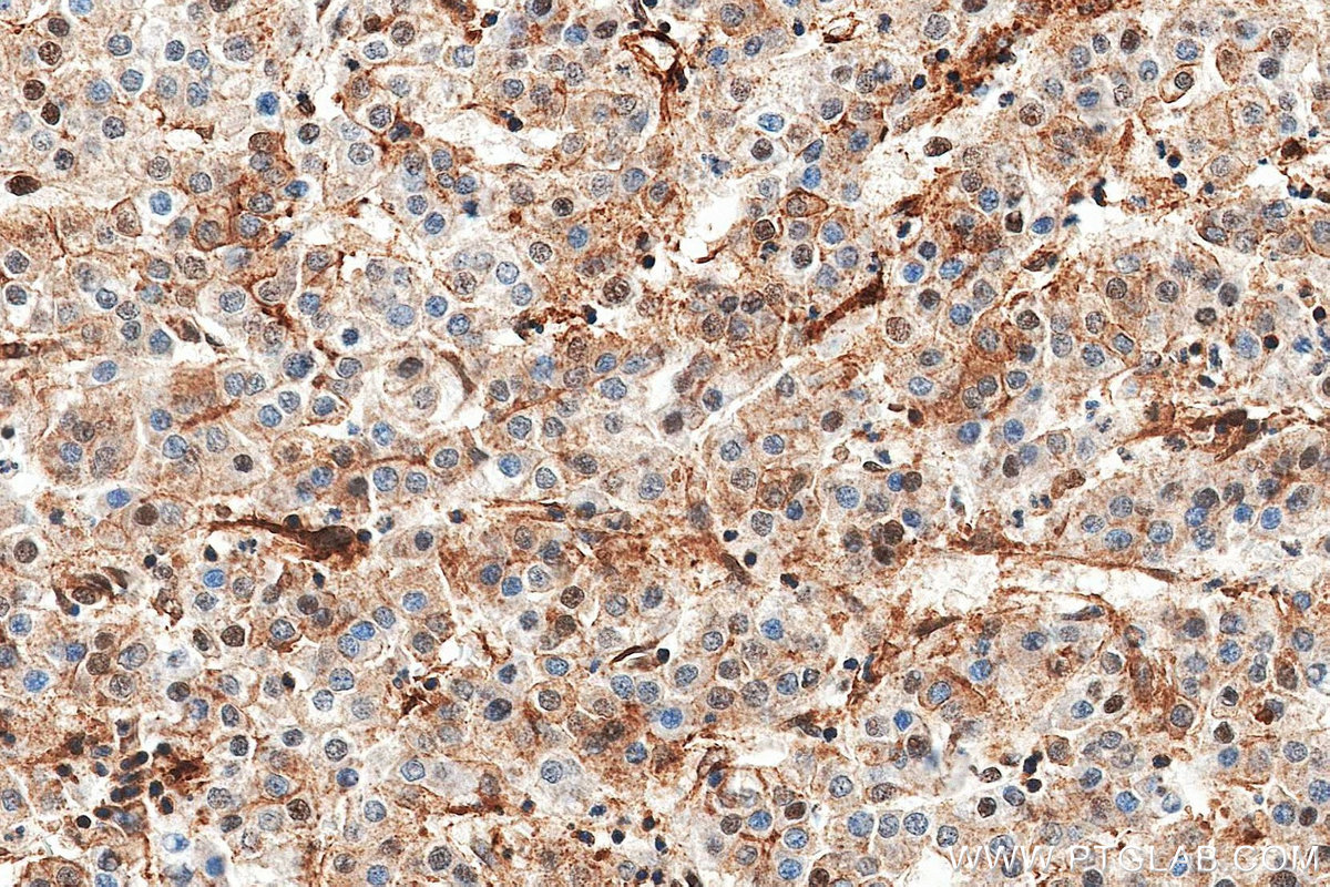 IHC staining of Human Hepatocellular cancer using 84824-2-RR