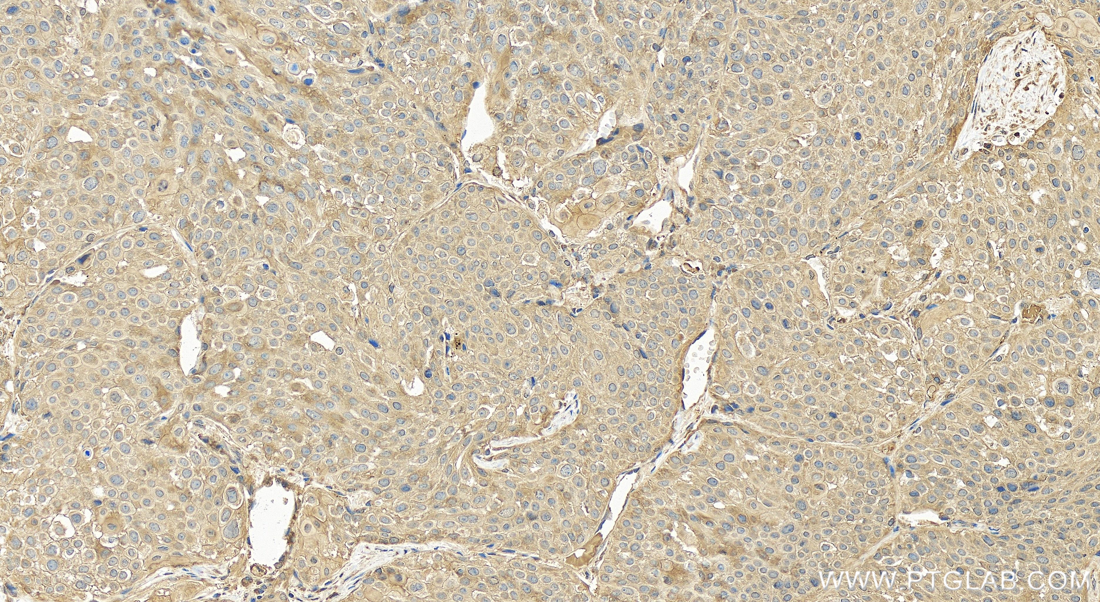 IHC staining of human lung cancer using 84966-2-RR (same clone as 84966-2-PBS)