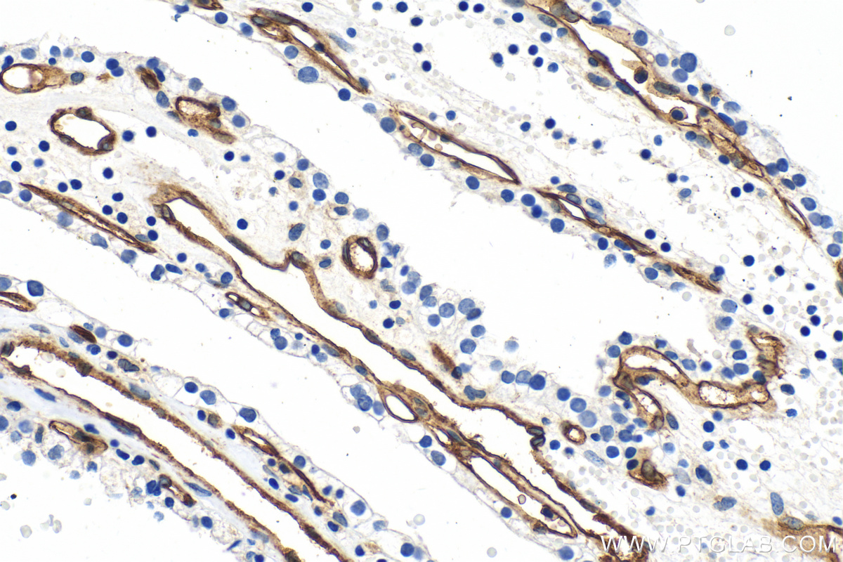 IHC staining of human renal cell carcinoma using 30730-1-AP