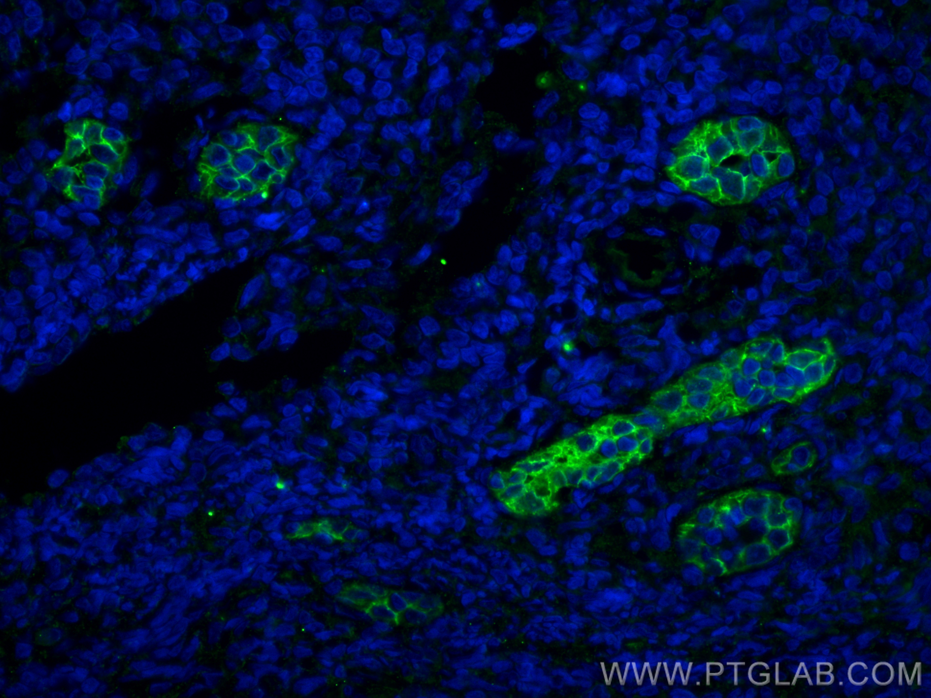 IF Staining of human tonsillitis using 67075-1-Ig