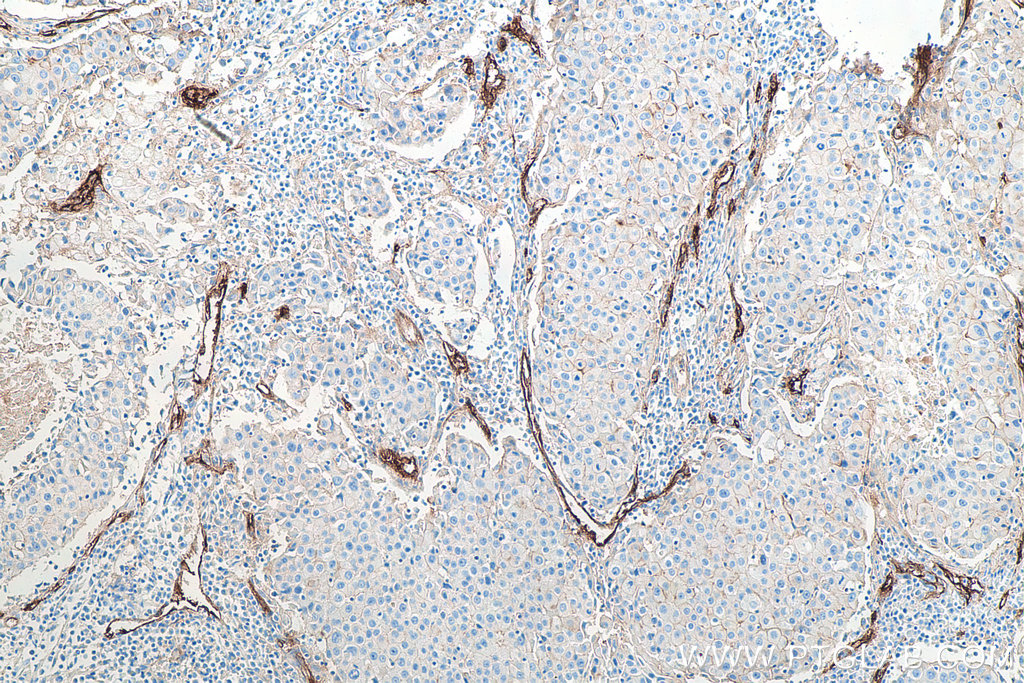 IHC staining of human breast cancer using 67075-1-Ig IHC staining of human breast cancer using 67075-1-Ig