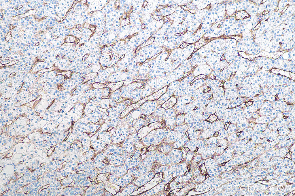 IHC staining of human liver cancer using 67075-1-Ig IHC staining of human liver cancer using 67075-1-Ig