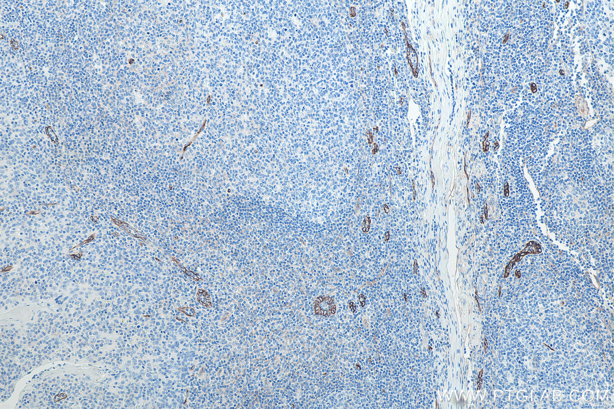 IHC staining of human tonsillitis using 67075-1-Ig IHC staining of human tonsillitis using 67075-1-Ig