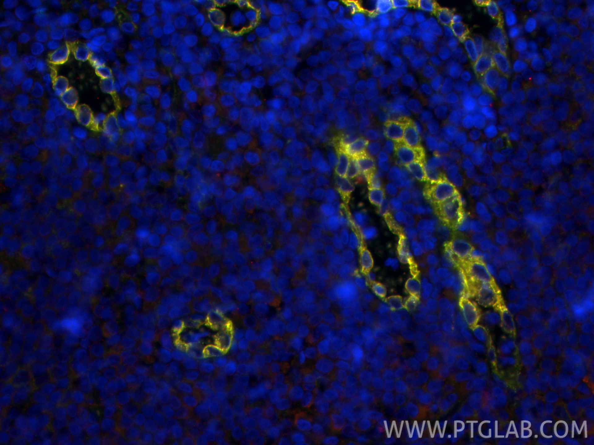 IF Staining of human tonsillitis using 82993-6-RR (same clone as 82993-6-PBS) IF Staining of human tonsillitis using 82993-6-RR (same clone as 82993-6-PBS)