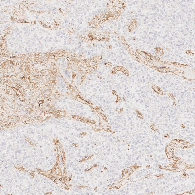 IHC staining of human liver cancer using 82993-6-RR