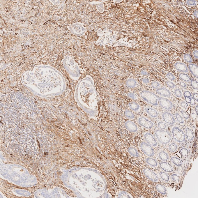 IHC staining of human colorectal cancer using 82993-6-RR