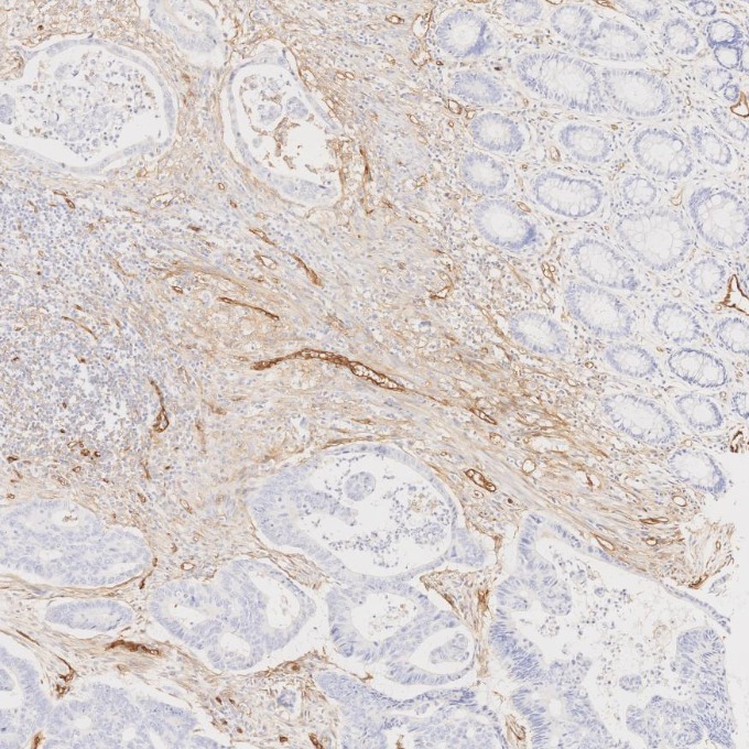 IHC staining of human colorectal cancer using 82993-6-RR