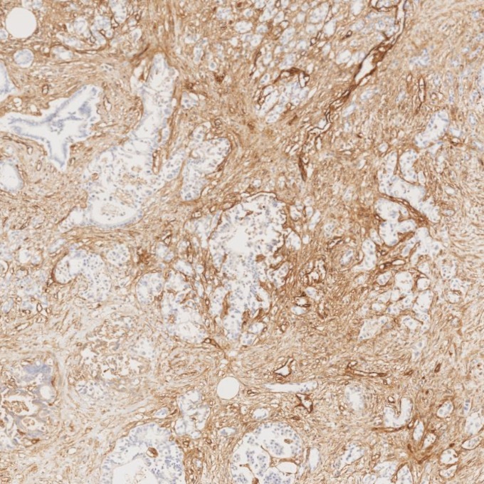 IHC staining of human pancreas cancer using 82993-6-RR