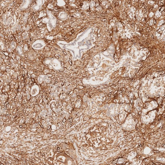 IHC staining of human pancreas cancer using 82993-6-RR