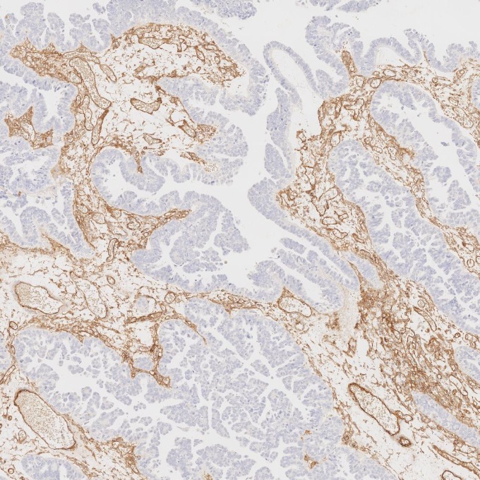 IHC staining of human ovary cancer using 82993-6-RR