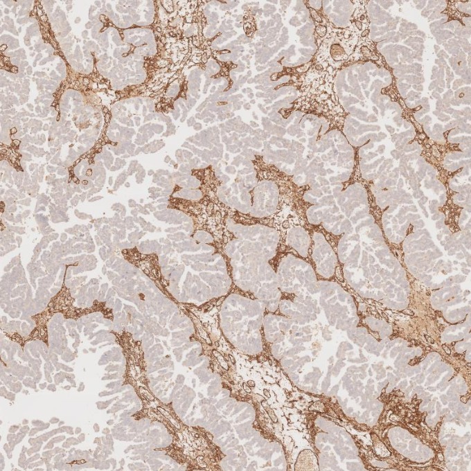 IHC staining of human ovary cancer using 82993-6-RR