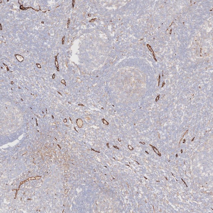 IHC staining of human tonsillitis using 82993-6-RR