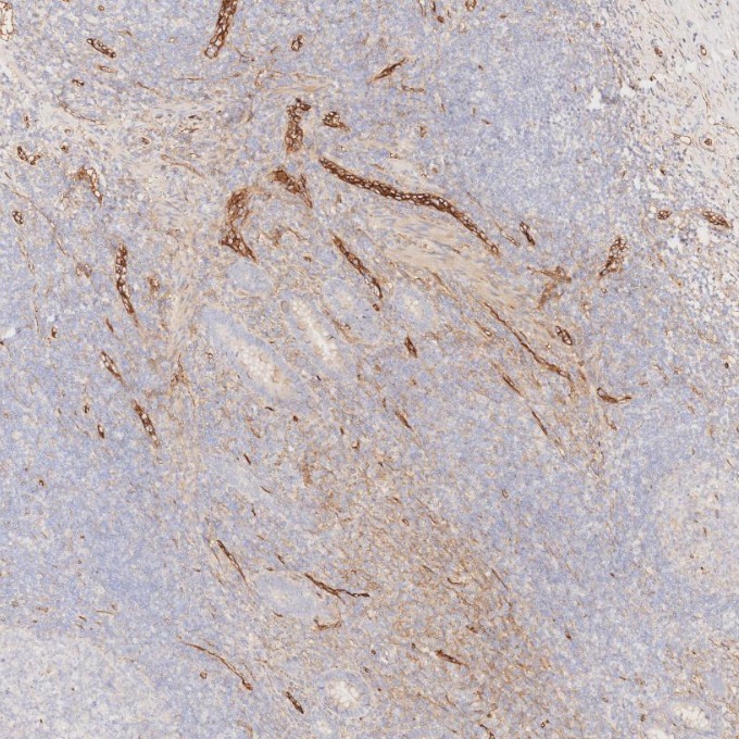 IHC staining of human appendicitis using 82993-6-RR