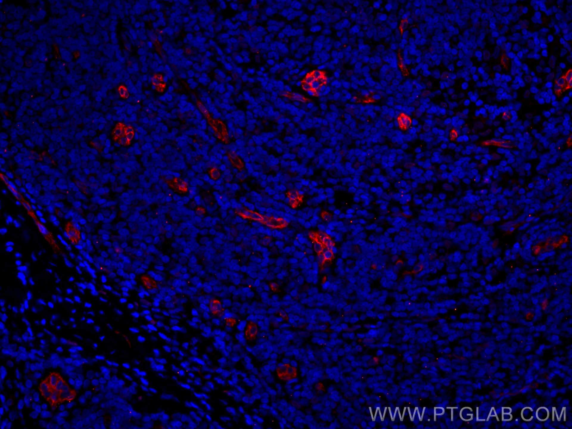 IF Staining of human breast cancer using CL594-67075