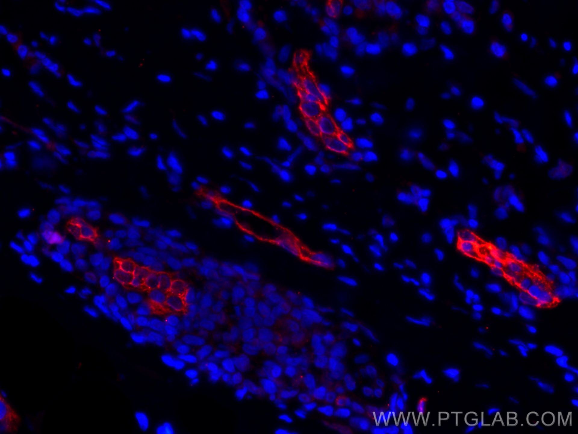 IF Staining of human breast cancer using CL594-67075