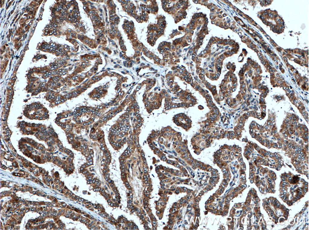 IHC staining of human thyroid cancer using 27871-1-AP