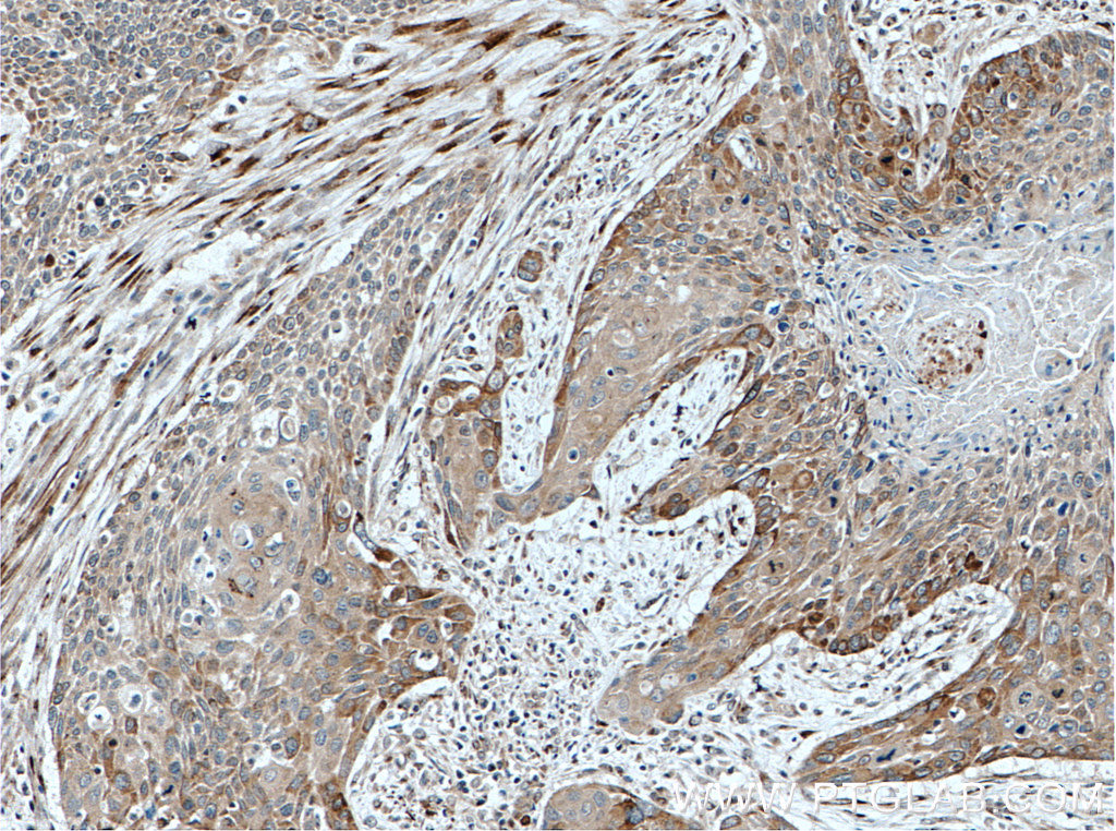 IHC staining of human oesophagus cancer using 27871-1-AP
