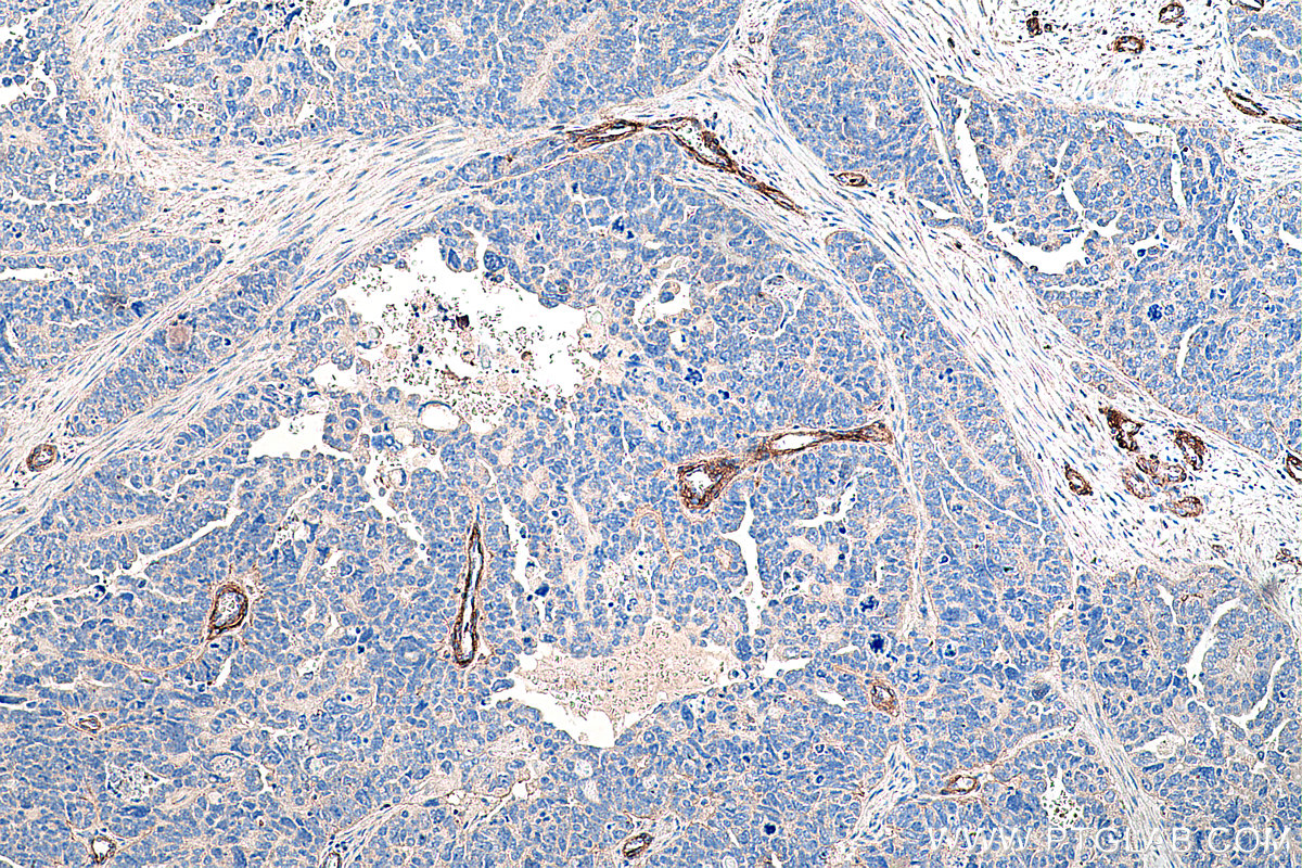 IHC staining of human ovary tumor using 67310-1-Ig