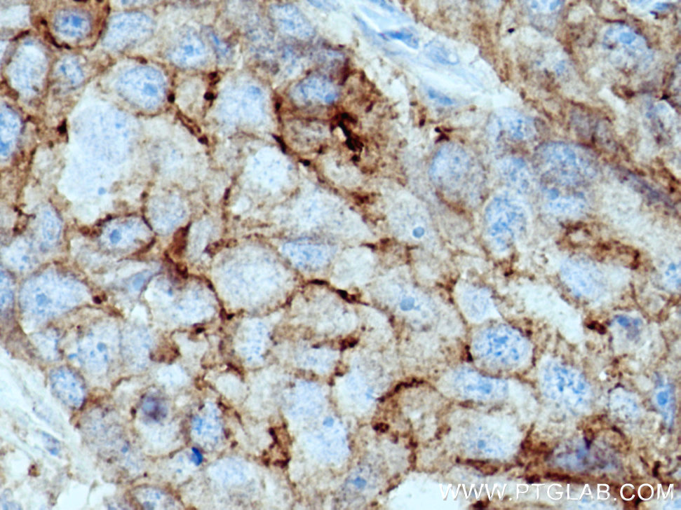 IHC staining of human breast cancer using 26941-1-AP