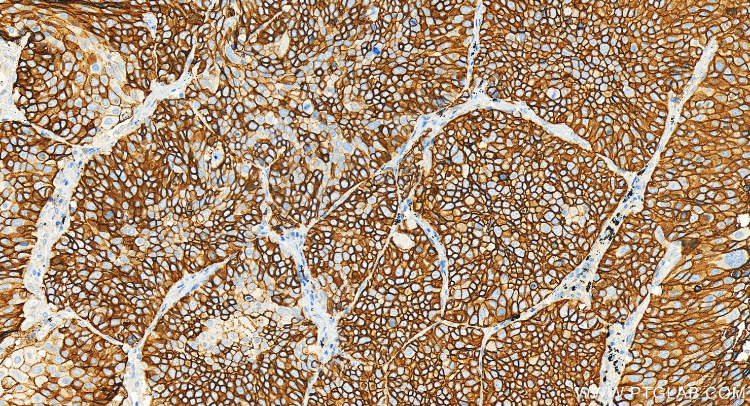 Immunohistochemical analysis of paraffin-embedded human lung squamous cell cancer slide using <a class='green' href='/productredirect?CatalogNo=67056-1-Ig' target='_blank'>67056-1-Ig</a> (Tissue Factor antibody) at dilution of 1:4000 (under 20x lens). Heat mediated antigen retrieval with Tris-EDTA buffer (pH 9.0). This data was developed using the same antibody clone with 67056-1-PBS in a different storage buffer formulation. IHC staining of human lung squamous cell cancer using 67056-1-Ig (same clone as 67056-1-PBS)