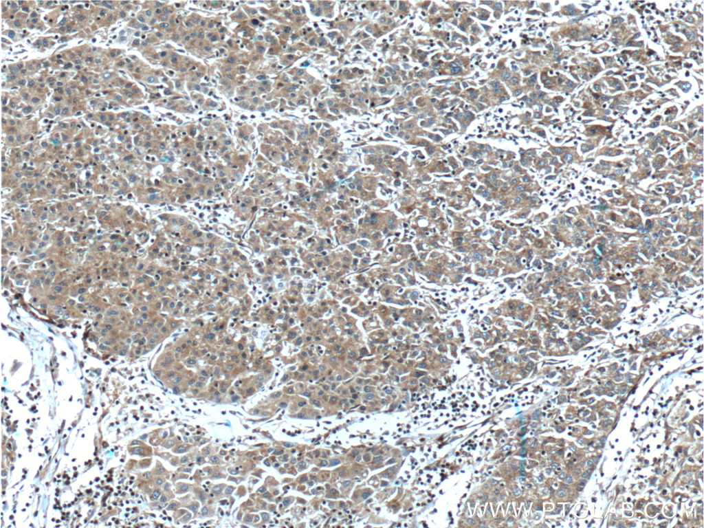 IHC staining of human liver cancer using 20963-1-AP