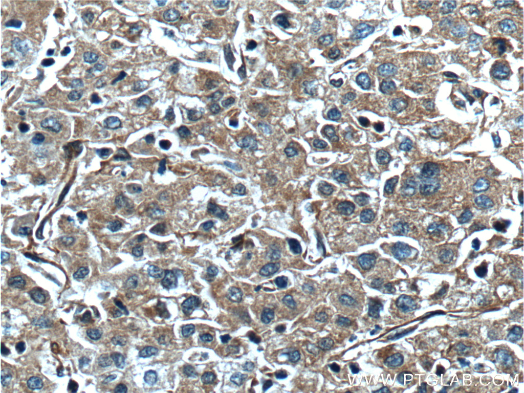 IHC staining of human liver cancer using 20963-1-AP