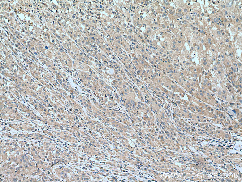 IHC staining of human liver cancer using 67607-1-Ig
