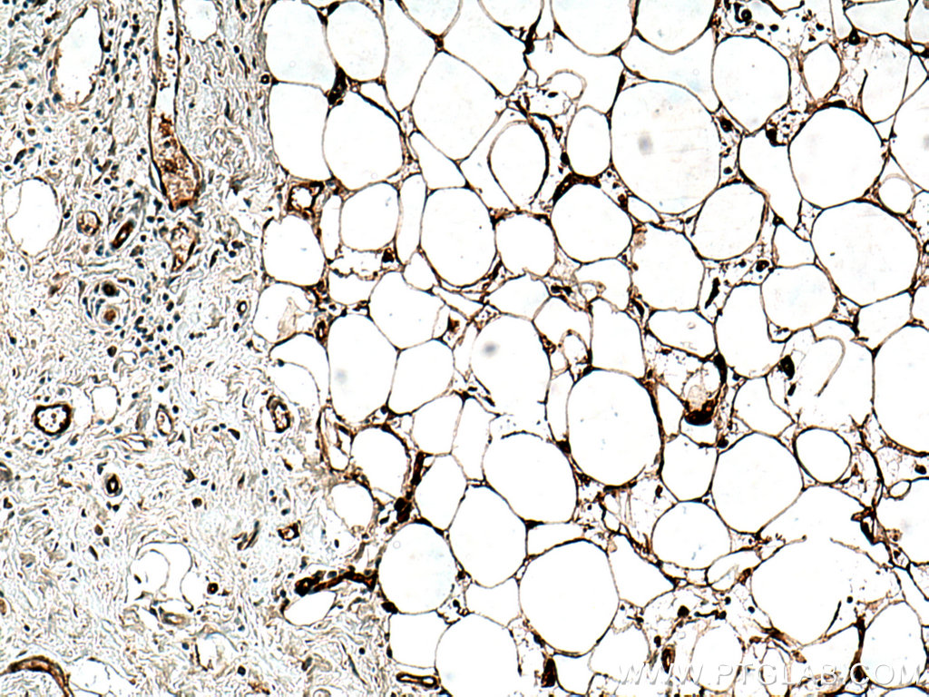IHC staining of human breast cancer using 67167-1-Ig (same clone as 67167-1-PBS)