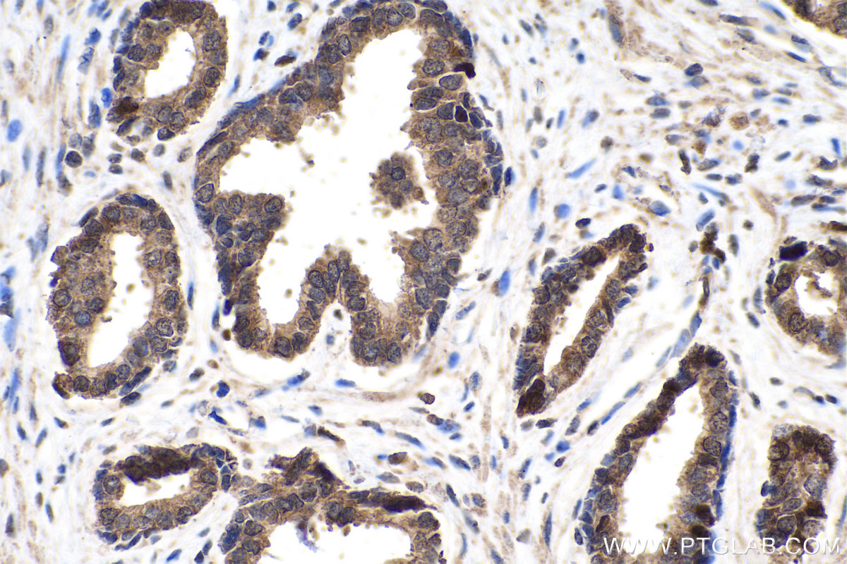 IHC staining of human prostate cancer using 66299-1-Ig