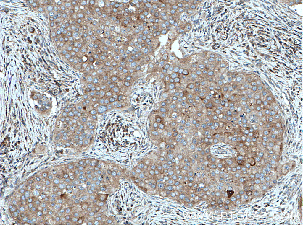 IHC staining of human breast cancer using 14836-1-AP