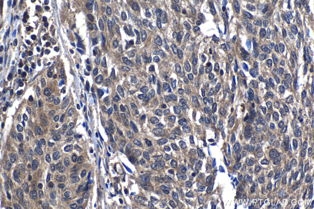 IHC staining of human cervical cancer using 14906-1-AP