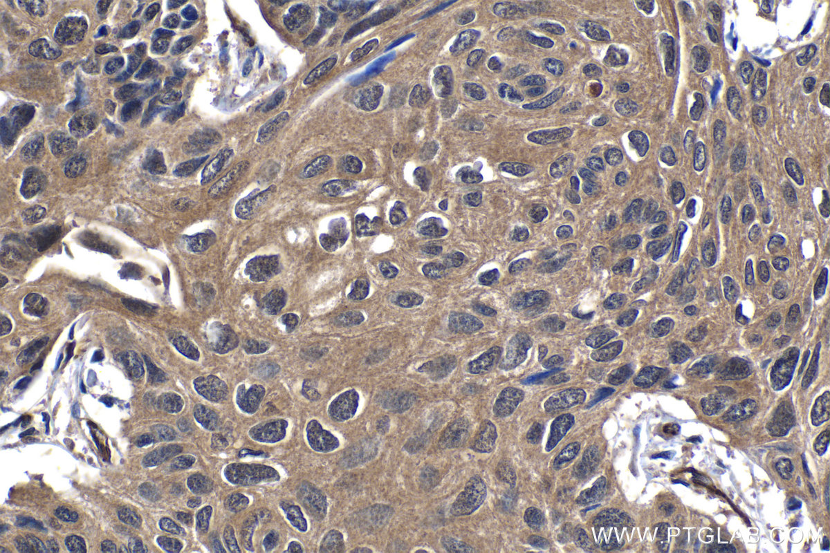 IHC staining of human lung cancer using 14906-1-AP
