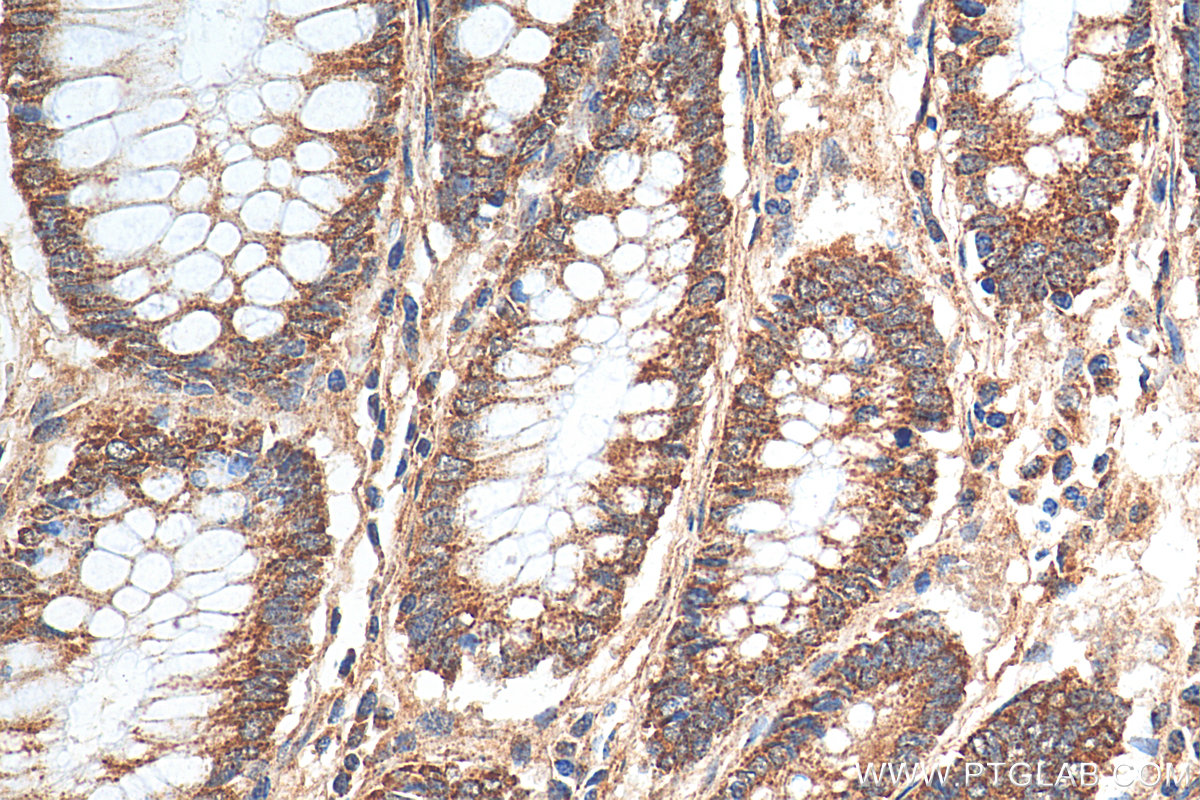 IHC staining of human colon cancer using 10627-1-AP