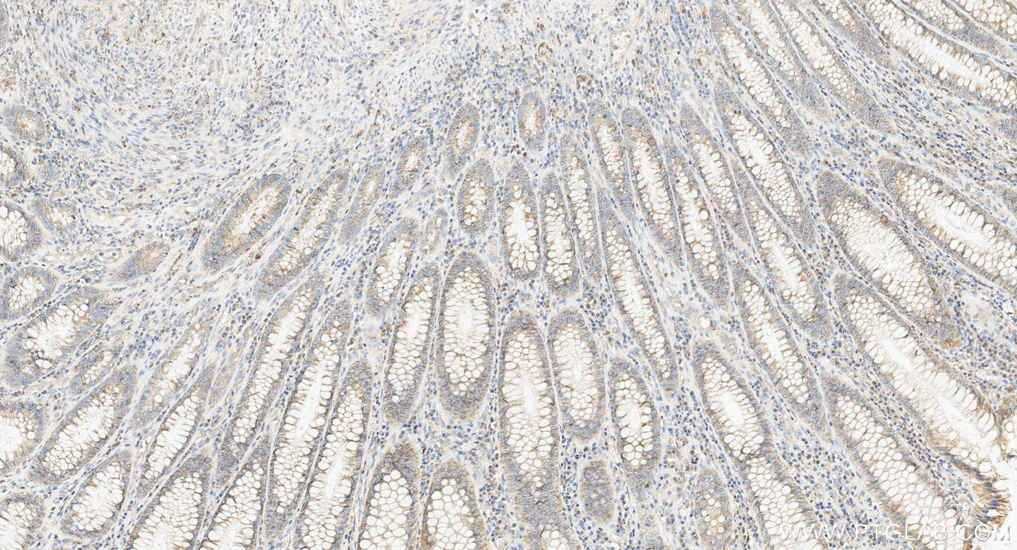 IHC staining of human colorectal cancer using 10627-1-AP