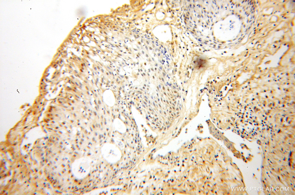 IHC staining of human prostate cancer using 10271-1-AP