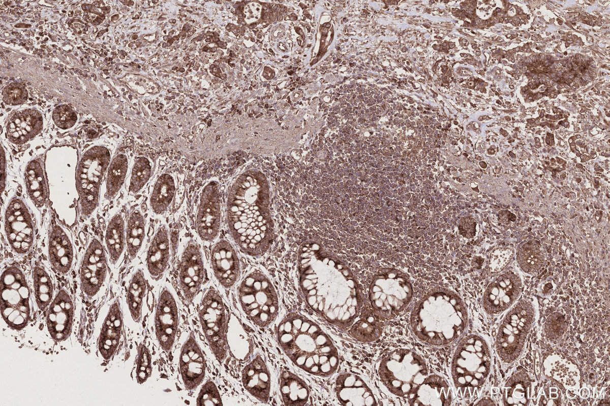 IHC staining of human rectal cancer using 66629-1-Ig